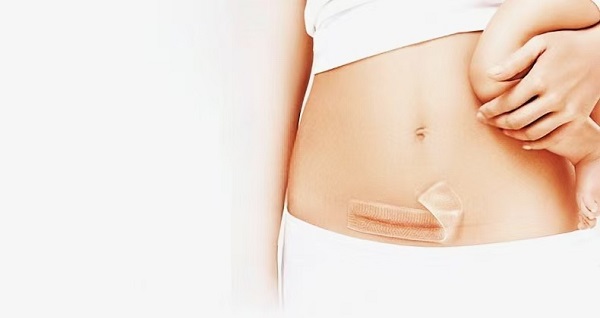 ¿Por qué son tan populares las láminas gruesas de gel de silicona para cicatrices?