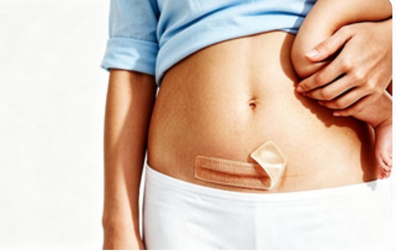 Parche seguro para cicatrices de silicona CmallBio sin hormonas para el cuidado de cicatrices por cesárea Parche seguro para cicatrices de silicona CmallBio sin hormonas para el cuidado de cicatrices por cesárea